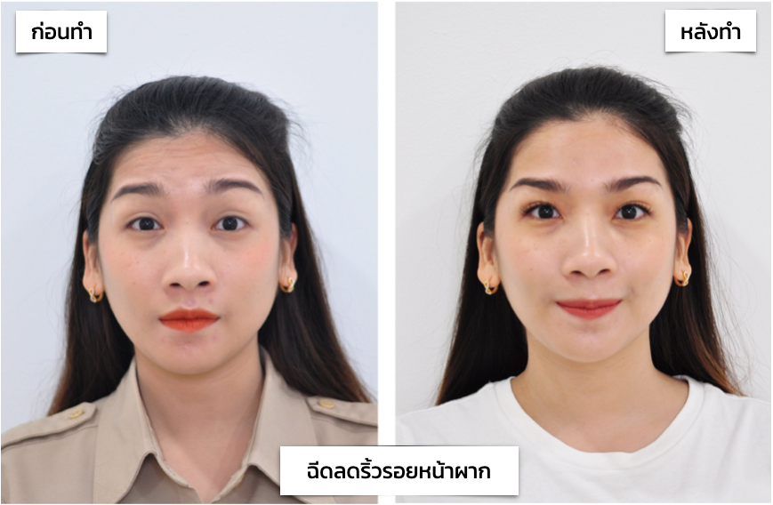 รีวิว รอยหน้าผาก รอยย่นหน้าผาก