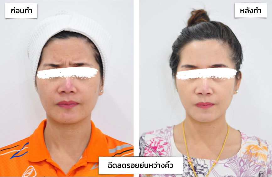 รีวิว รอยย่นหว่างคิ้ว ขมวดคิ้ว