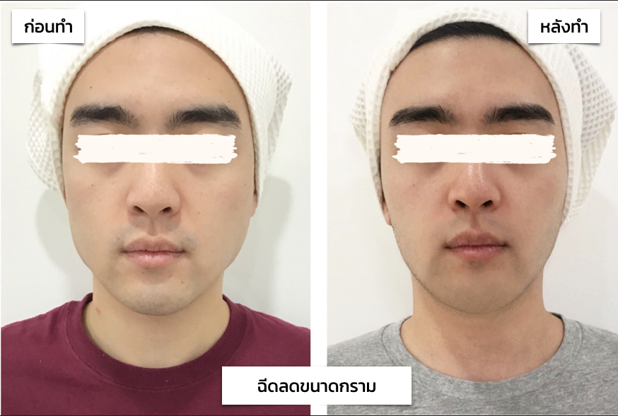 รีวิว ลดกราม