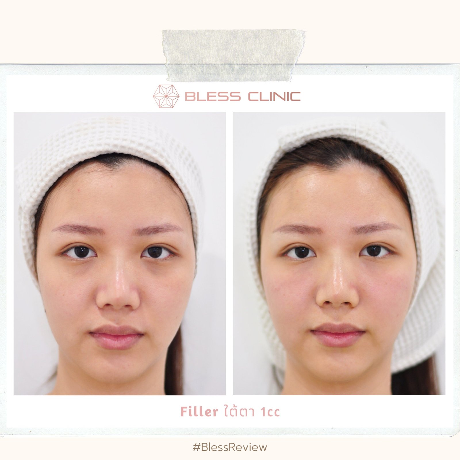 Filler Restylane