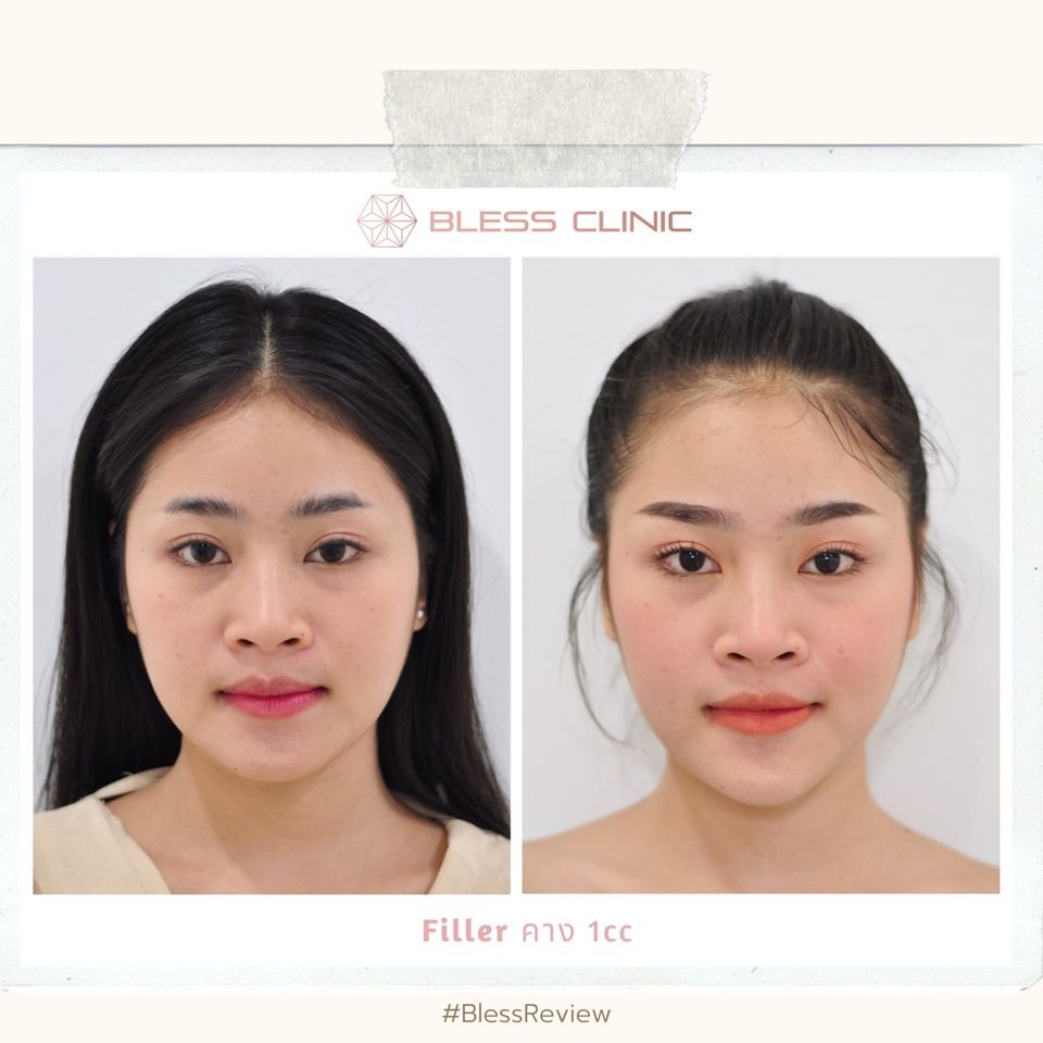 Filler คาง K.น้ำตาล