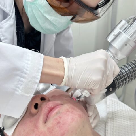 Pico Laser Bless 1