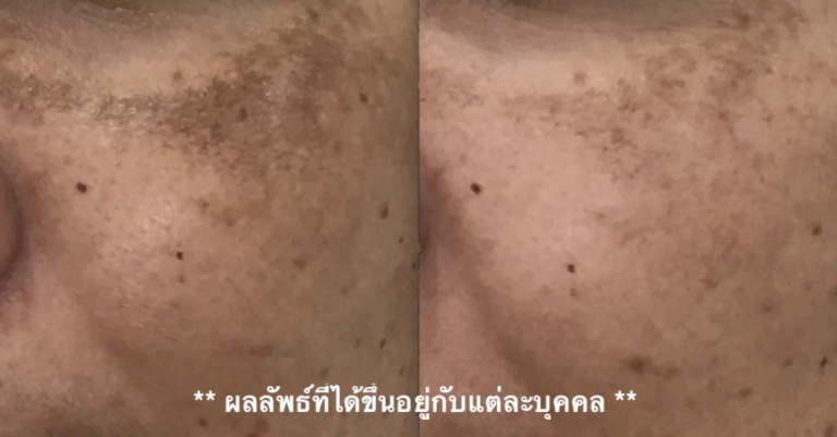 ฝ้า กระ melasma