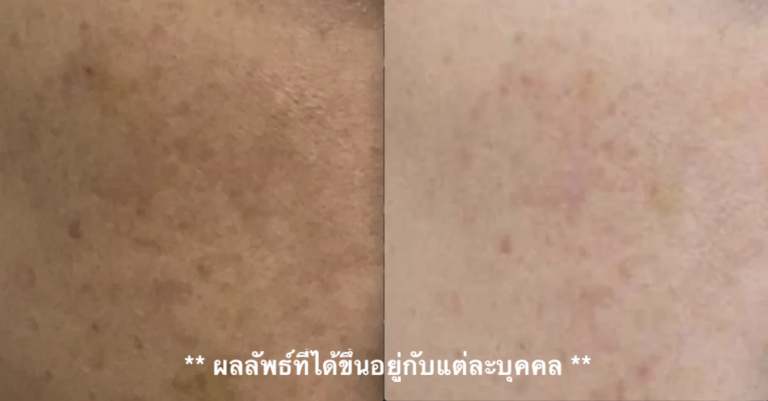 ฝ้า กระ melasma