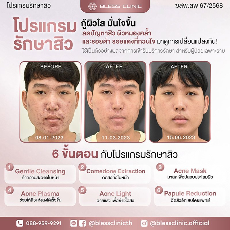 โปรแกรมดูแลปัญหาสิว Acne Away